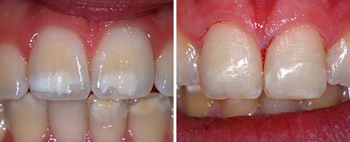 Frenectomy Treatment