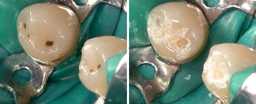 Composite Material Removal