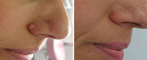 Fibroma Removal