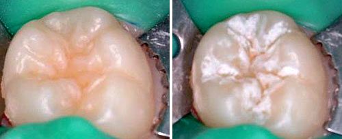 Fissure Sealing