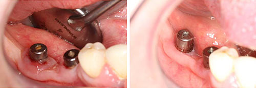 Peri-implant Mucositis