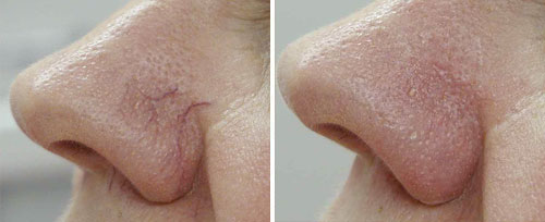 Vascular Lesions